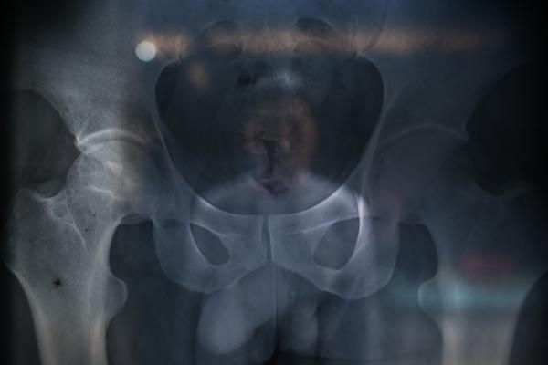 不知情的當(dāng)?shù)卮迕裰钡?005年仍食用污染田地生產(chǎn)的大米，不少村民被檢測(cè)出鎘超標(biāo)。10年前，黃懷權(quán)的髖關(guān)節(jié)股骨頭壞死，手術(shù)后，他喪失了勞動(dòng)能力。 權(quán)義 澎湃資料